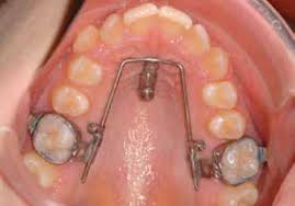 Aparat ortodontyczny bez jedynki przez 3 miesiące-bene.jpg